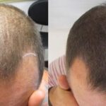 What is Scalp Micropigmentation for Hair Loss?